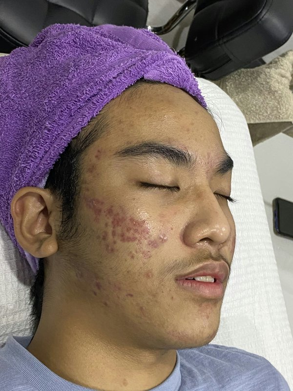 Comment choisir des produits de soin pour prévenir et traiter l'acné hormonale?